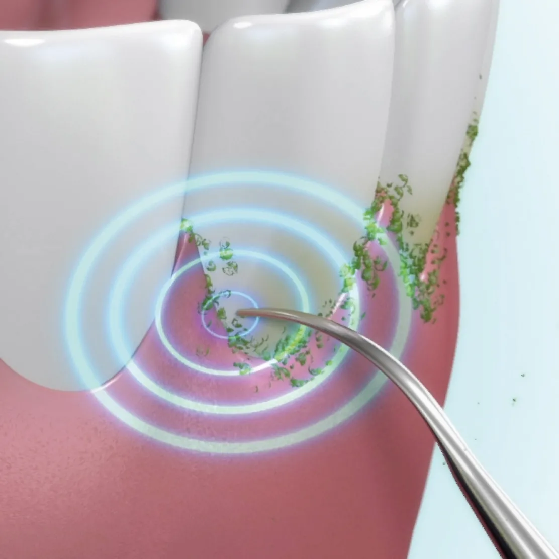 Détartreur ultrasons